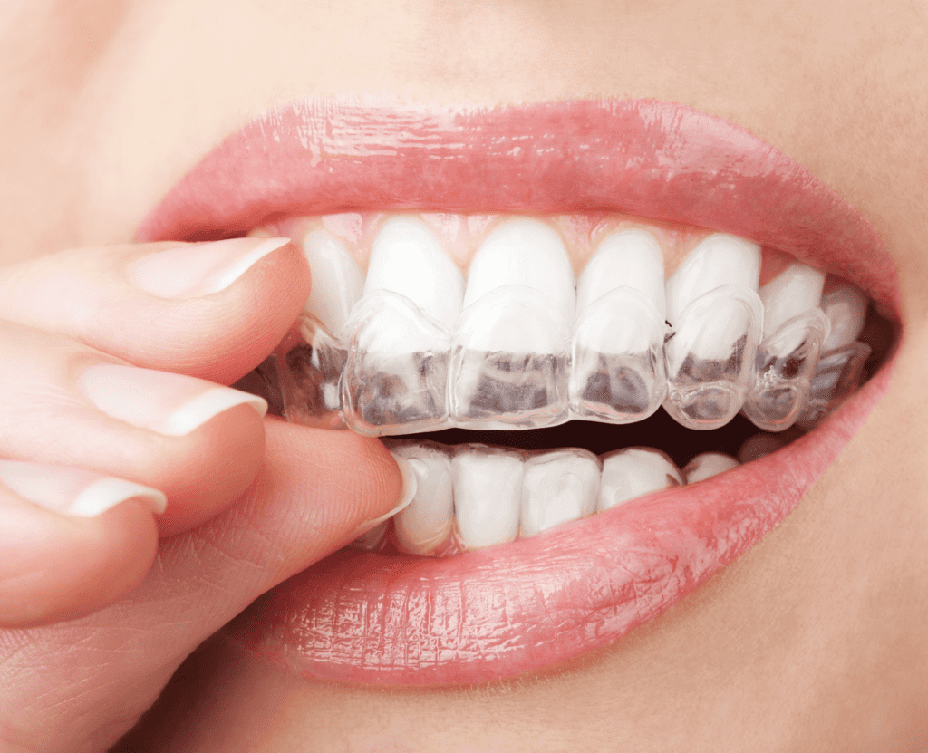 How Invisalign Can Benefit Your Children | Ottawa Dentist